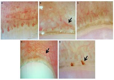 Nailfold Capillaroscopy With USB Digital Microscopy in Connective Tissue Diseases: A Comparative Study of 245 Patients and Healthy Controls